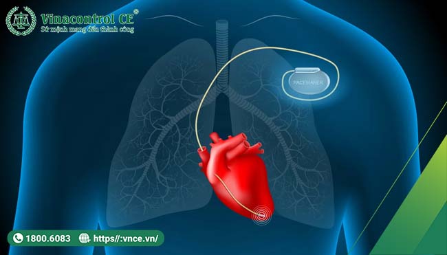 Máy tạo nhịp tim ngoài cơ thể